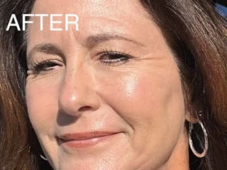 Laser Treatment Before & After Gallery - Patient 381798 - Image 2