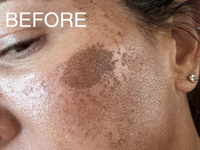 Laser Treatment Before & After Gallery - Patient 381798 - Image 3