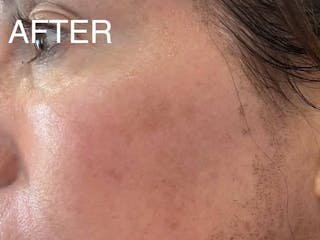 Laser Treatment Before & After Gallery - Patient 381798 - Image 4