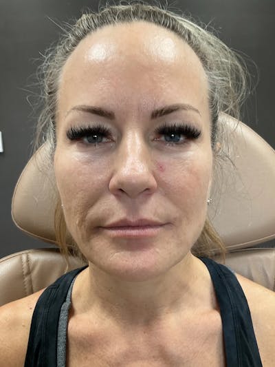 Microneedling Treatment Before & After Gallery - Patient 445499 - Image 1