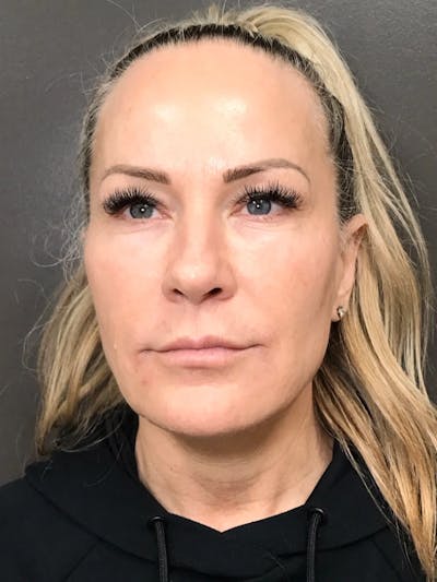 Microneedling Treatment Before & After Gallery - Patient 445499 - Image 2