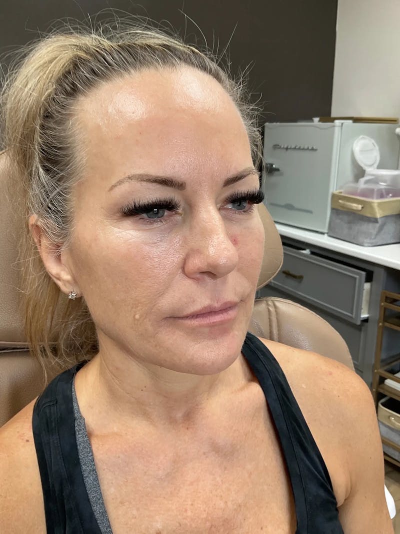 Microneedling Treatment Before & After Gallery - Patient 445499 - Image 3