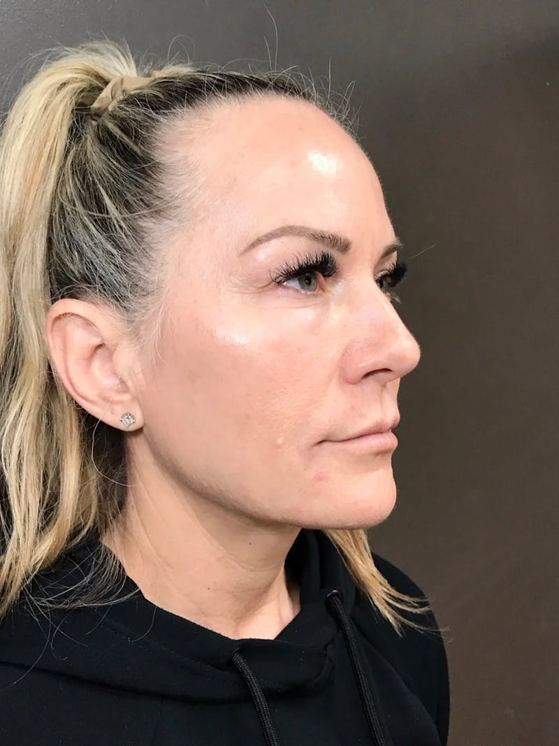 Microneedling Treatment Before & After Gallery - Patient 445499 - Image 4