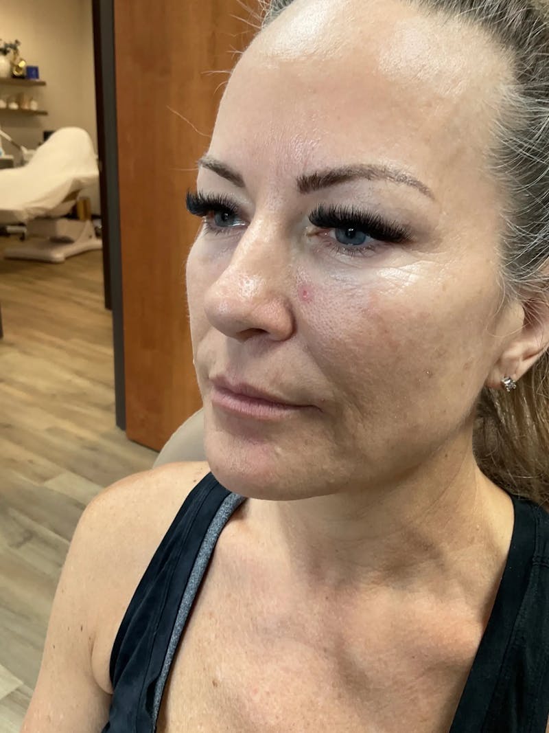 Microneedling Treatment Before & After Gallery - Patient 445499 - Image 5