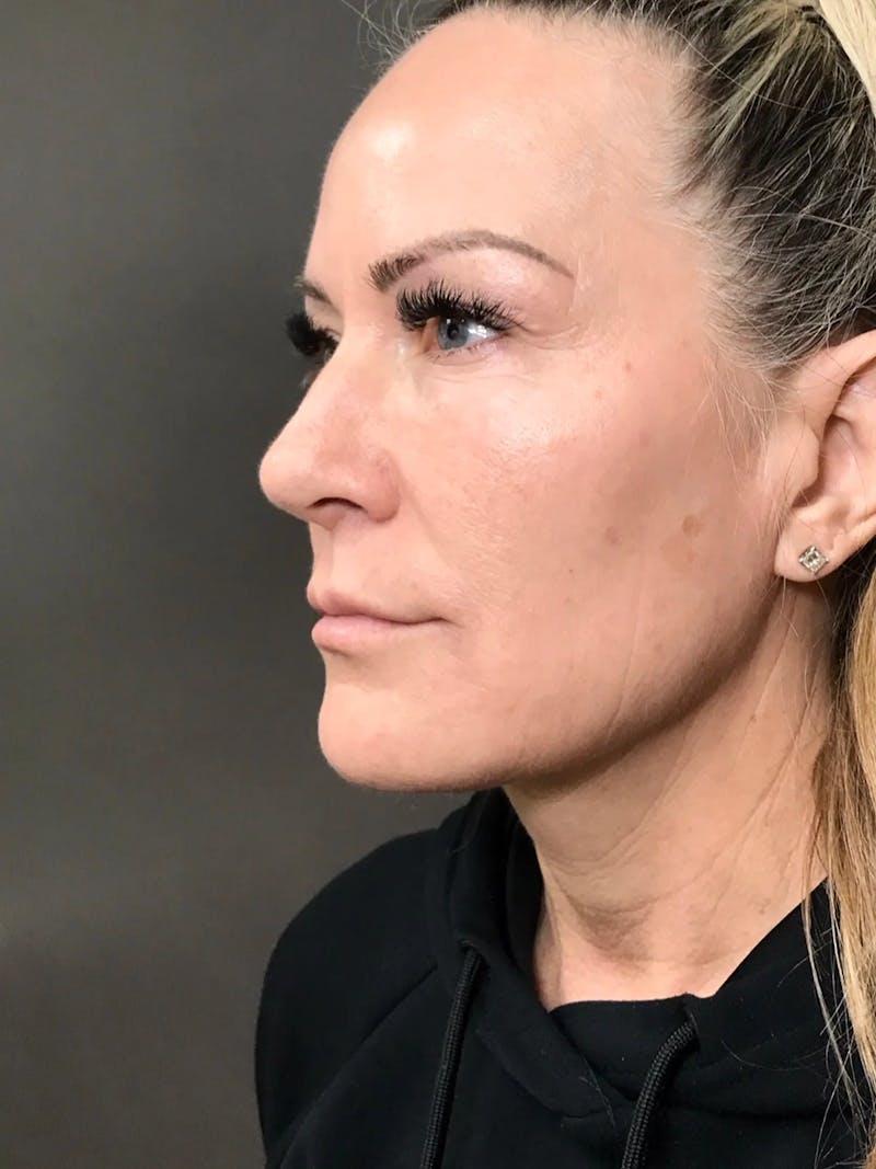 Microneedling Treatment Before & After Gallery - Patient 445499 - Image 6