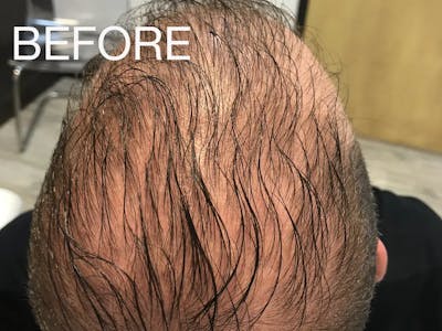 Natural Growth Factor Injections Before & After Gallery - Patient 496444 - Image 1