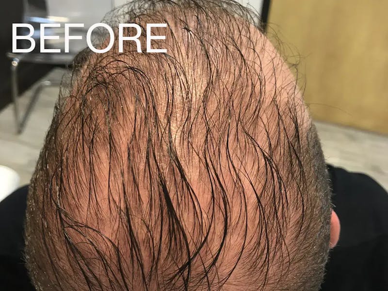 Natural Growth Factor Injections Before & After Gallery - Patient 496444 - Image 1