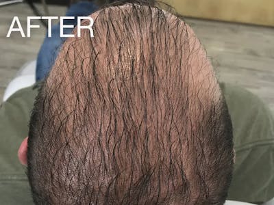 Natural Growth Factor Injections Before & After Gallery - Patient 496444 - Image 2