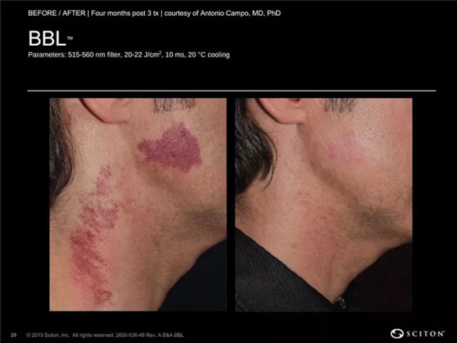 BBL laser patient results