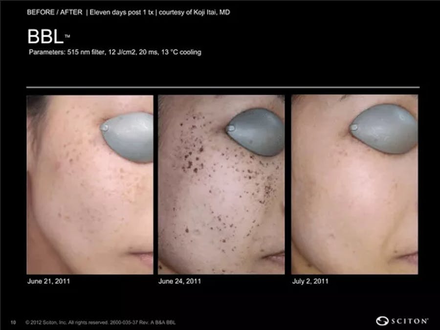 BBL laser patient results