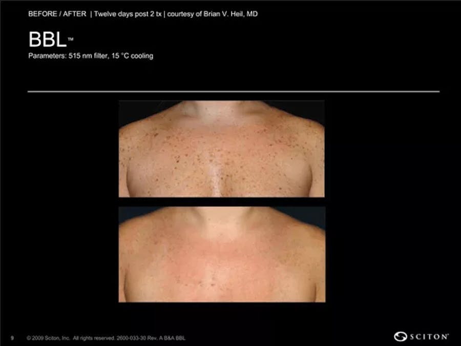 BBL laser patient results