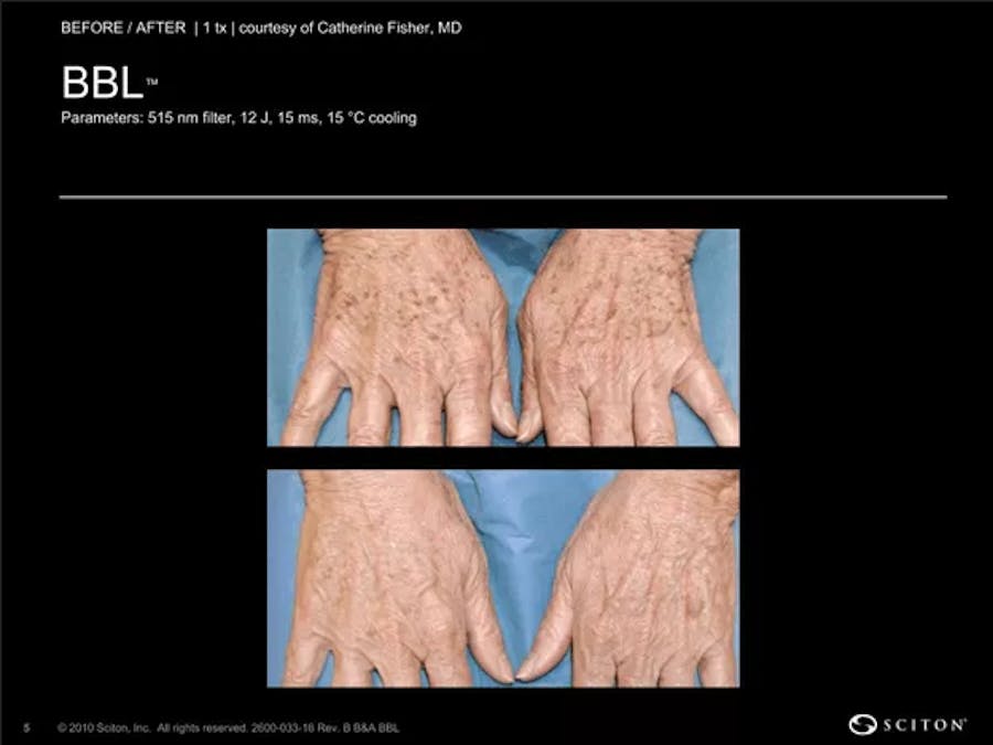 BBL laser patient results