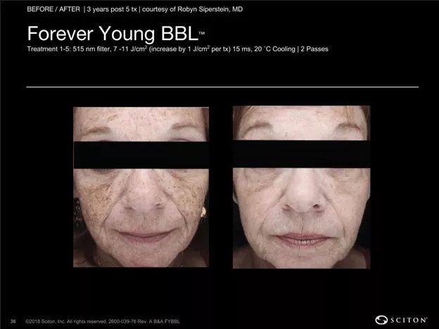 bbl laser patient results