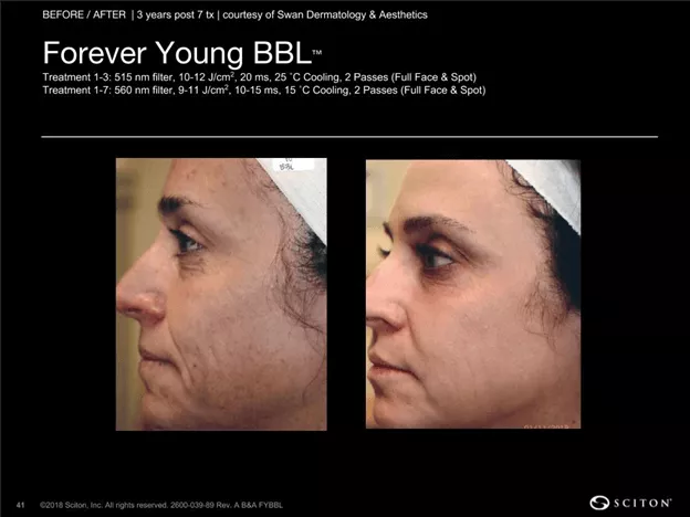 bbl laser patient results