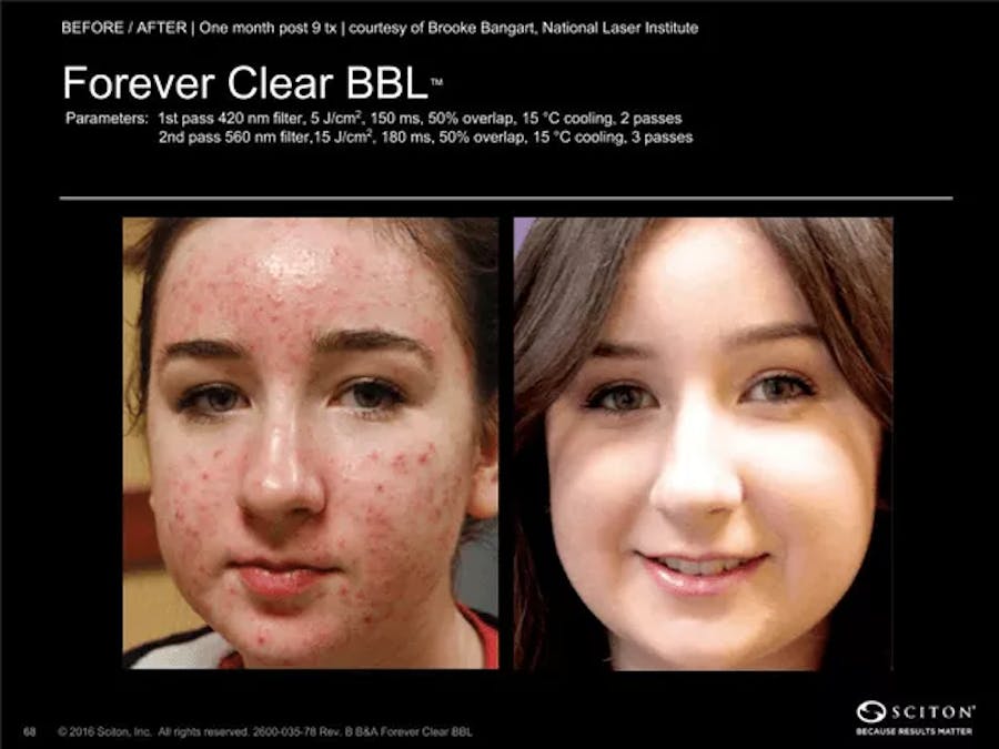 bbl laser patient results