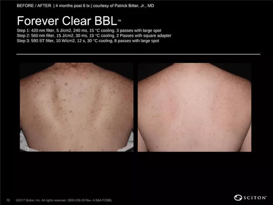 bbl laser patient results