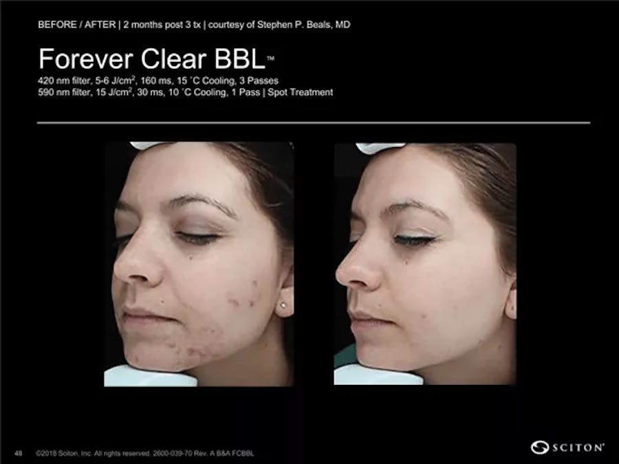 bbl laser patient results