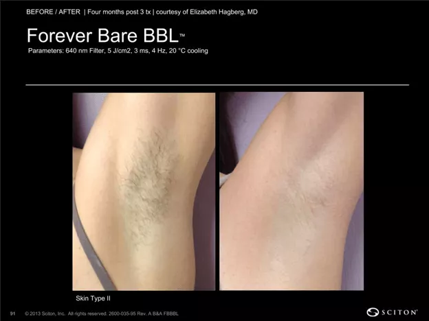bbl laser patient results