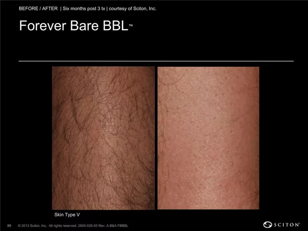 bbl laser patient results