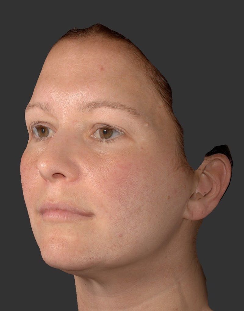 Laser Treatment Before & After Gallery - Patient 267484 - Image 1