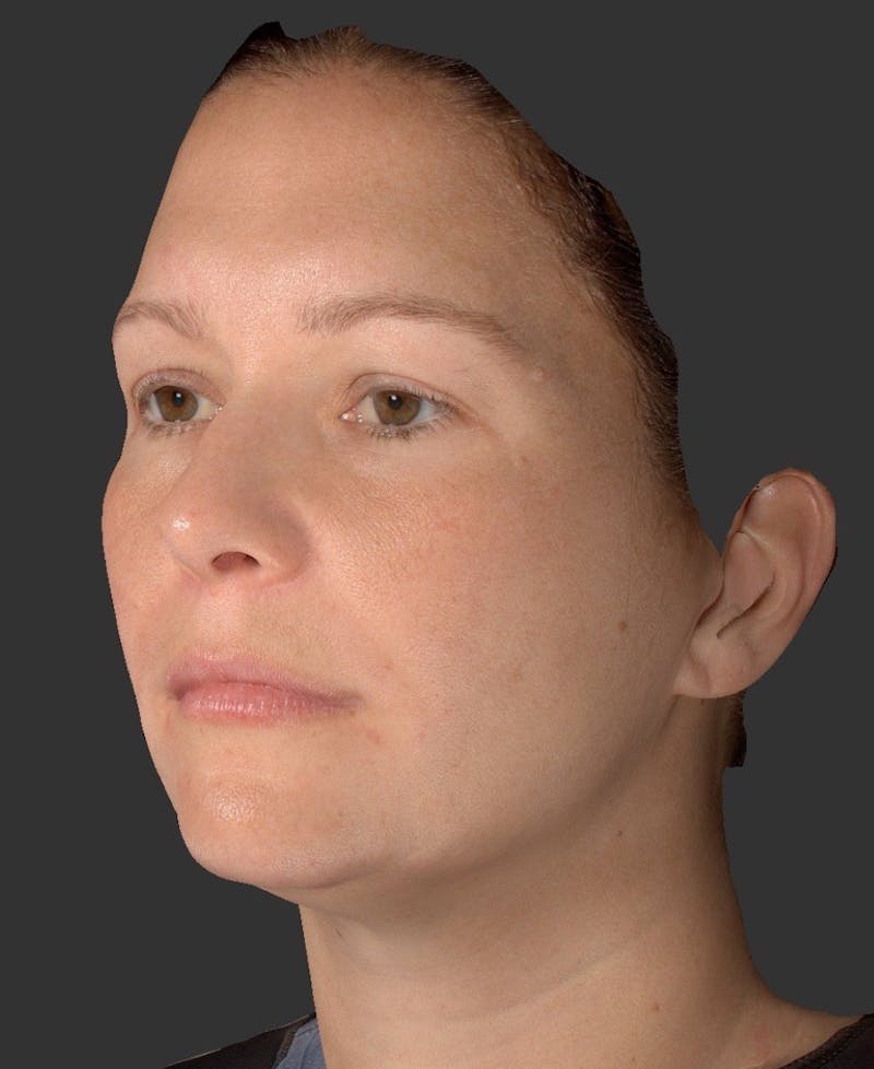 Laser Treatment Before & After Gallery - Patient 267484 - Image 2
