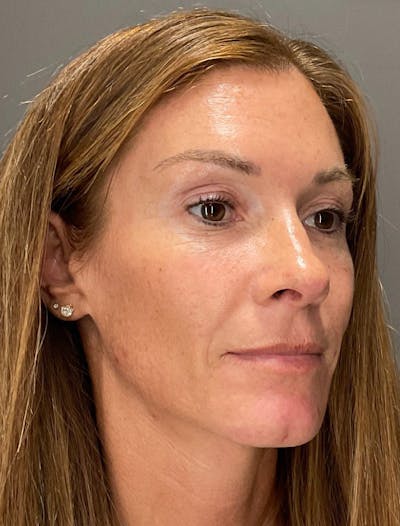 Skin Care Protocol Before & After Gallery - Patient 285839 - Image 1