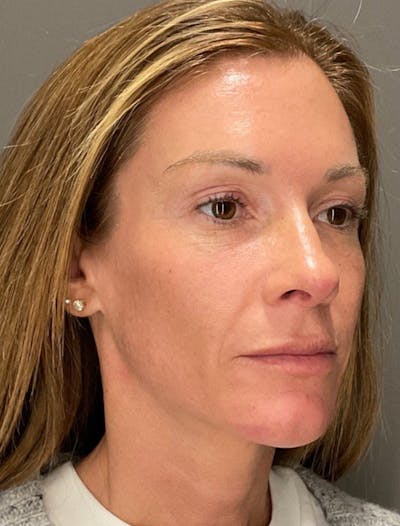 Skin Care Protocol Before & After Gallery - Patient 285839 - Image 2