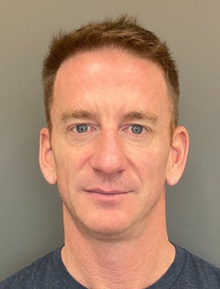 Chin Filler Before & After Gallery - Patient 244391 - Image 2