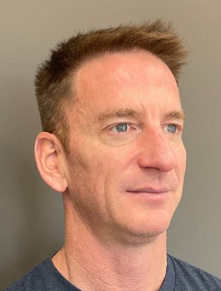 Chin Filler Before & After Gallery - Patient 244391 - Image 4