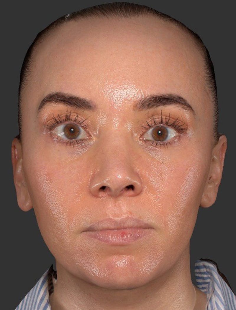 Skin Care Protocol Before & After Gallery - Patient 986431 - Image 1