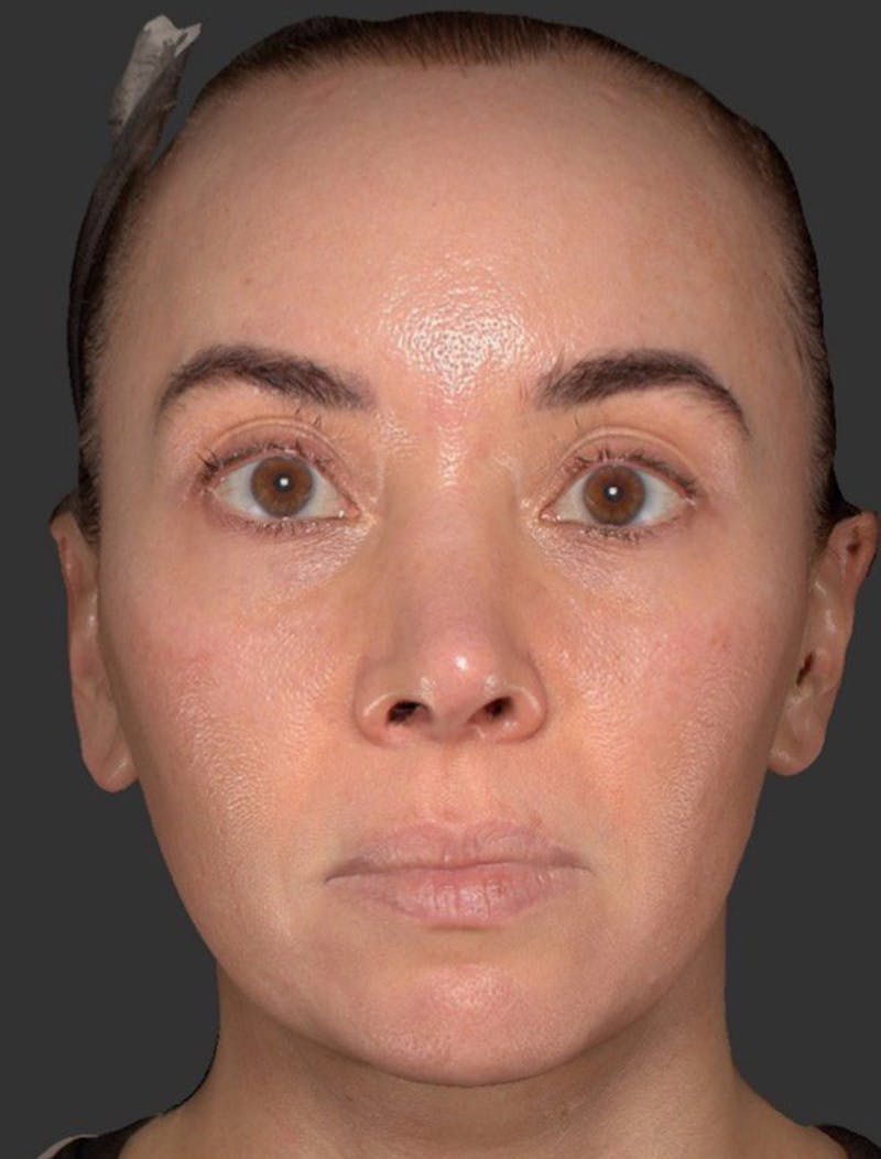 Skin Care Protocol Before & After Gallery - Patient 986431 - Image 2