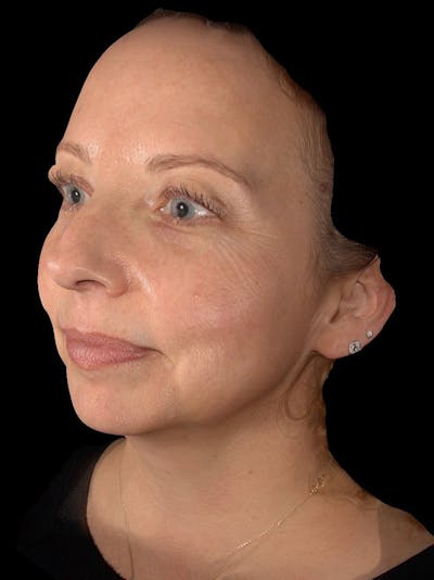 Skin Care Protocol Before & After Gallery - Patient 216979 - Image 1