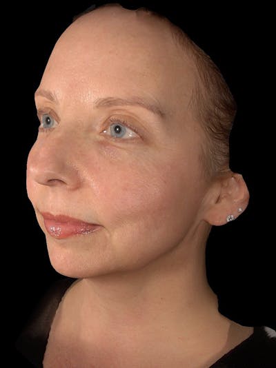 Skin Care Protocol Before & After Gallery - Patient 216979 - Image 2