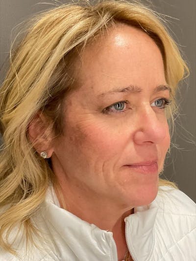 Skin Care Protocol Before & After Gallery - Patient 680615 - Image 1