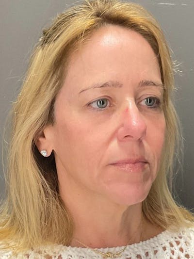 Skin Care Protocol Before & After Gallery - Patient 680615 - Image 2