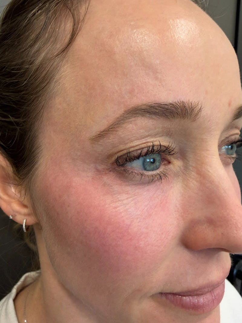 Natural Growth Factor Injections Before & After Gallery - Patient 189253 - Image 1