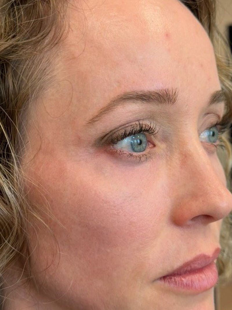 Natural Growth Factor Injections Before & After Gallery - Patient 189253 - Image 2
