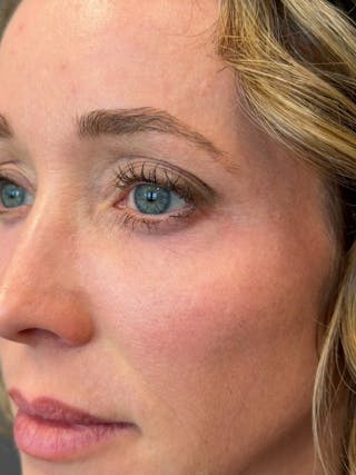 Natural Growth Factor Injections Before & After Gallery - Patient 189253 - Image 4