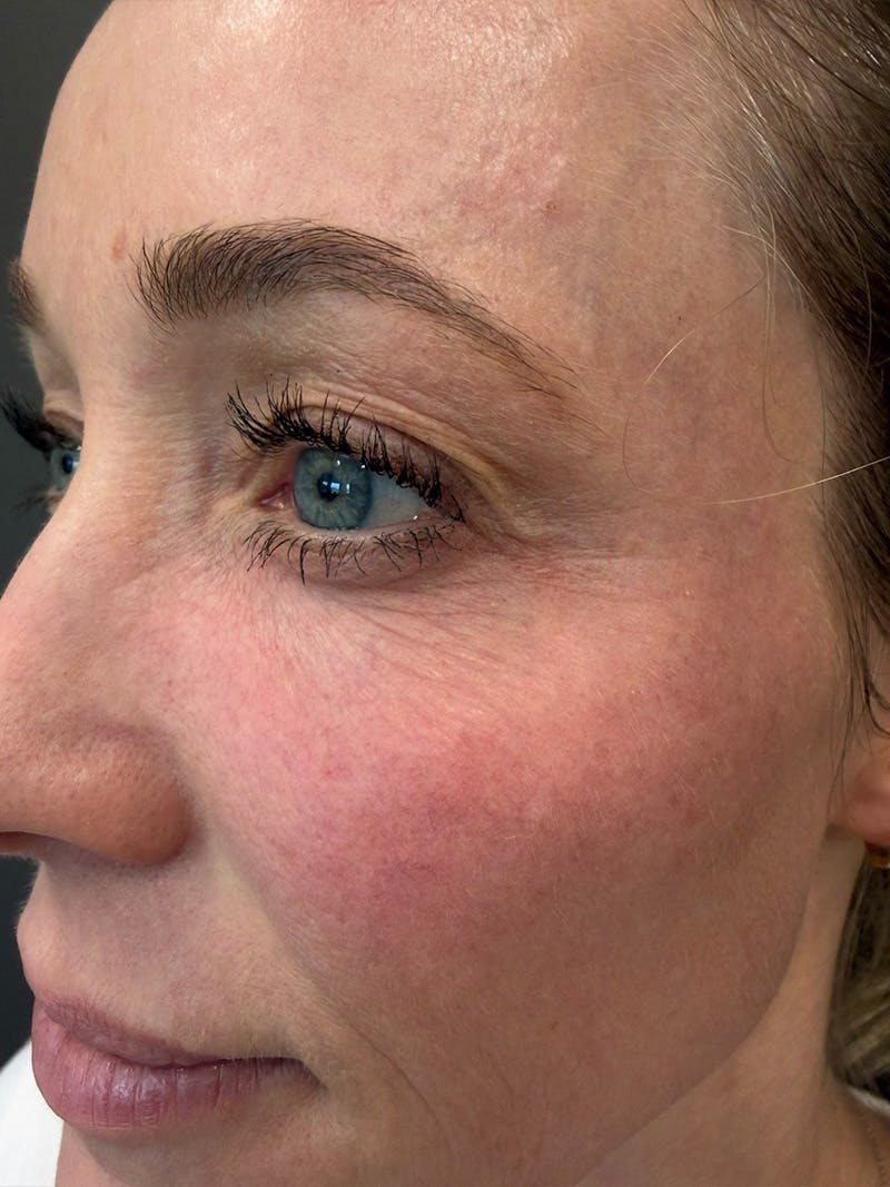 Natural Growth Factor Injections Before & After Gallery - Patient 189253 - Image 3