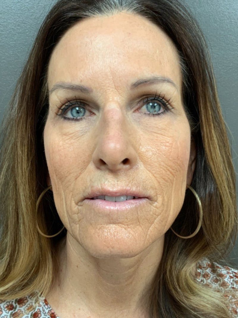 Full Face Rejuvenation Before & After Gallery - Patient 308806 - Image 1