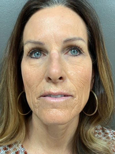 Full Face Rejuvenation Before & After Gallery - Patient 308806 - Image 1