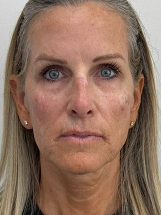 Full Face Rejuvenation Before & After Gallery - Patient 308806 - Image 2