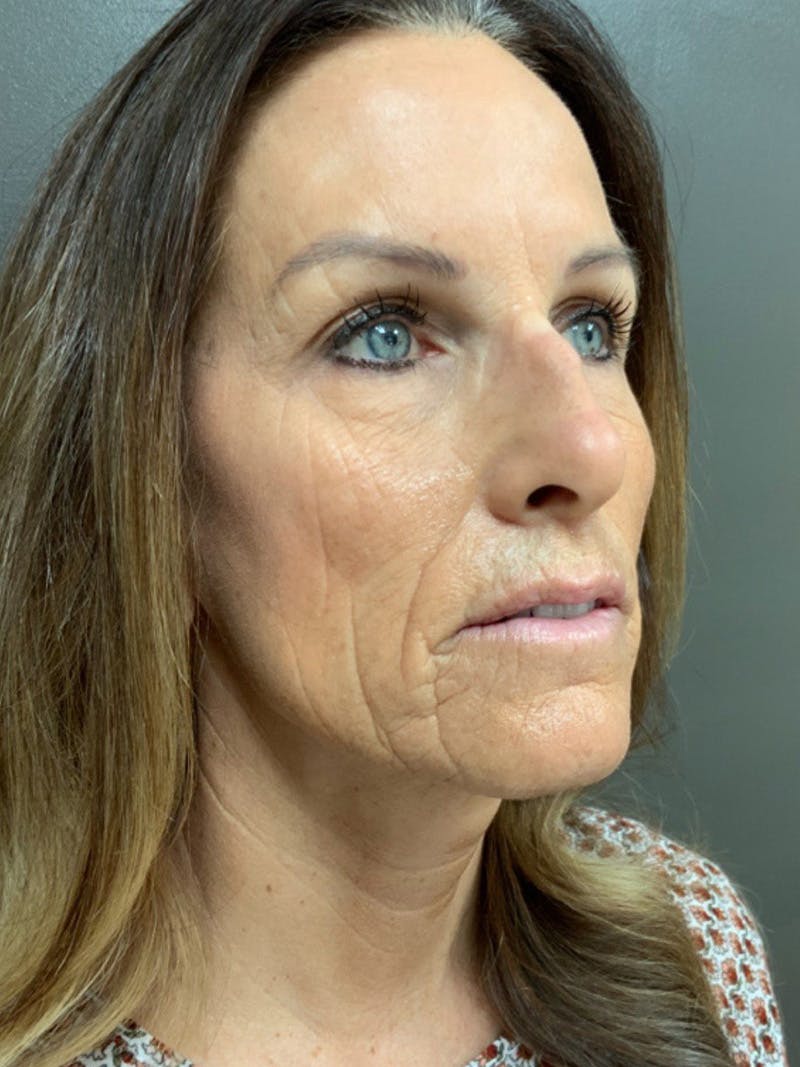 Full Face Rejuvenation Before & After Gallery - Patient 308806 - Image 3