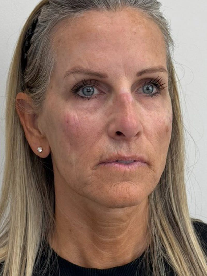 Full Face Rejuvenation Before & After Gallery - Patient 308806 - Image 4