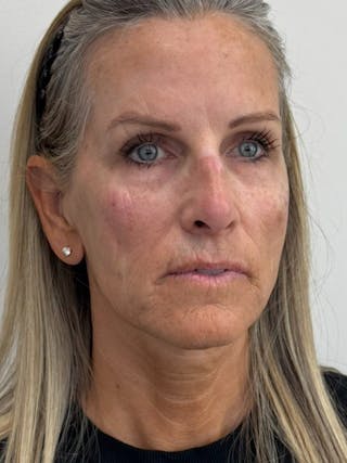 Full Face Rejuvenation Before & After Gallery - Patient 308806 - Image 4