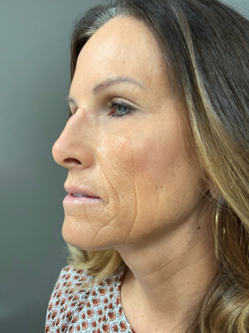 Full Face Rejuvenation Before & After Gallery - Patient 308806 - Image 5