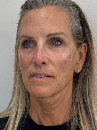 Full Face Rejuvenation Before & After Gallery - Patient 308806 - Image 6