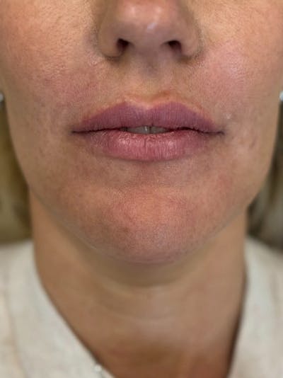 Lip Filler Before & After Gallery - Patient 229122 - Image 1