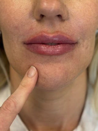 Lip Filler Before & After Gallery - Patient 229122 - Image 2