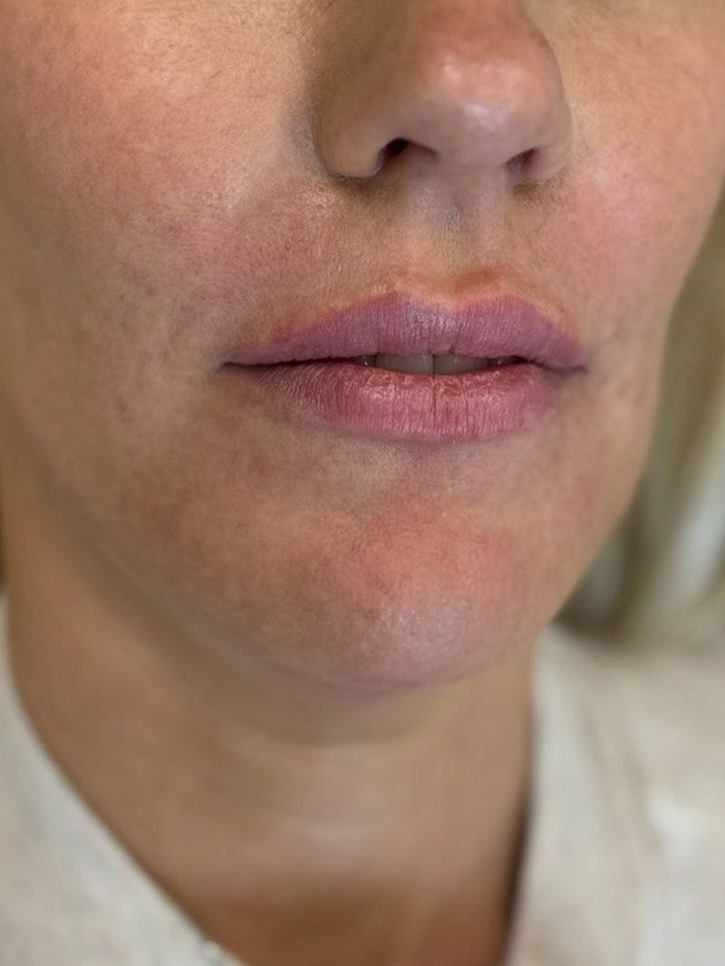 Lip Filler Before & After Gallery - Patient 229122 - Image 3